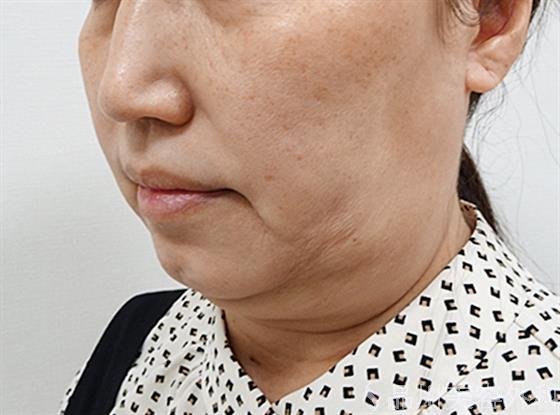 症例NO.61740のBEFORE写真
