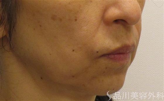 症例NO.56967のBEFORE写真