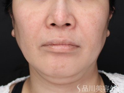 症例NO.71598のBEFORE写真