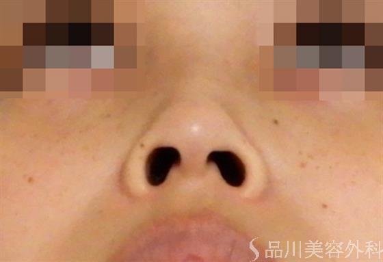 症例NO.38169のAFTER写真