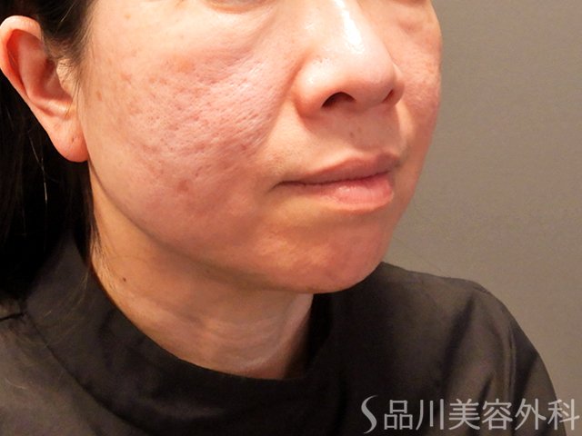 症例NO.68477のBEFORE写真