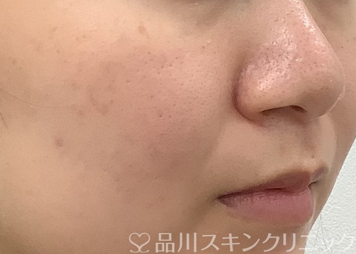 症例NO.69530のAFTER写真
