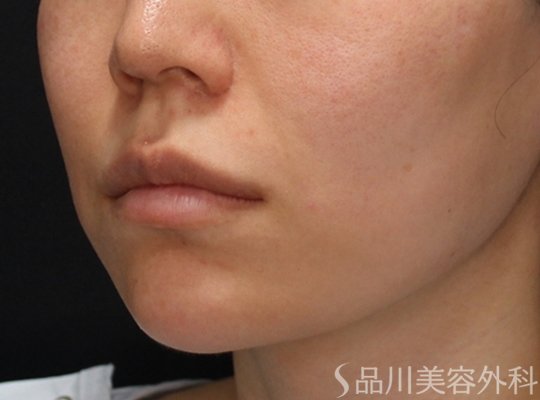 症例NO.74949のBEFORE写真