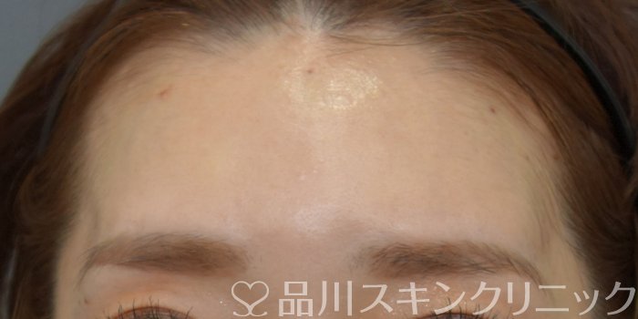 症例NO.74027のAFTER写真