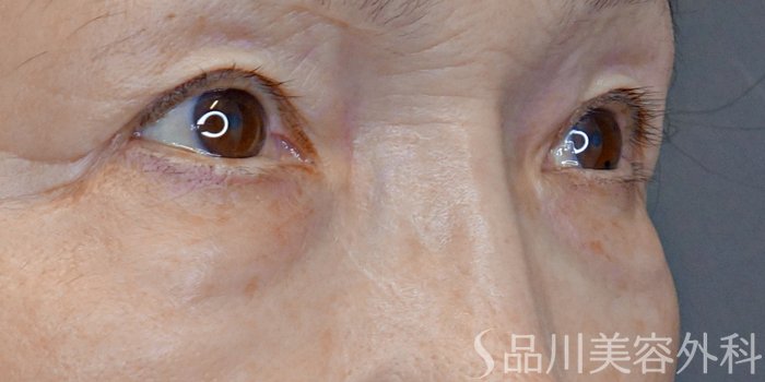 症例NO.72206のBEFORE写真