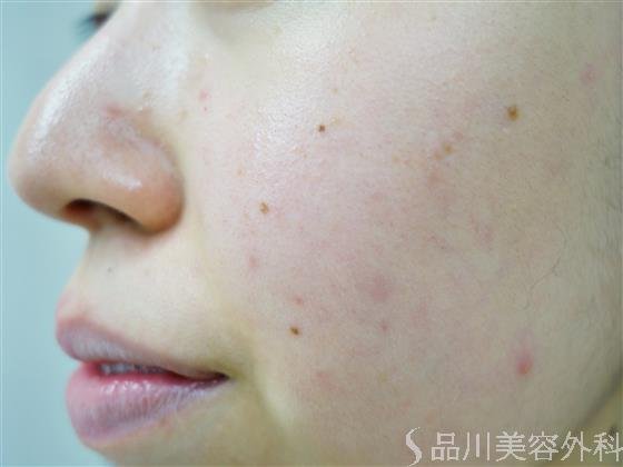 症例NO.40446のBEFORE写真