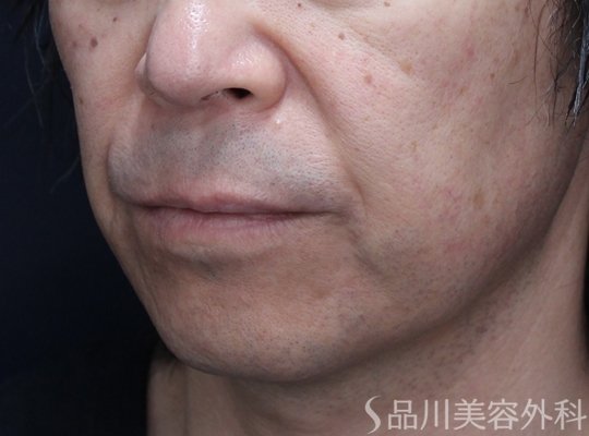 症例NO.71508のBEFORE写真