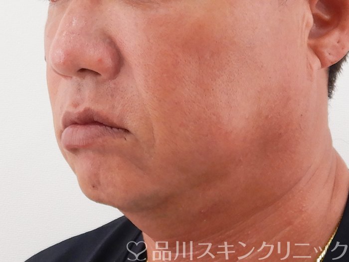症例NO.62191のBEFORE写真