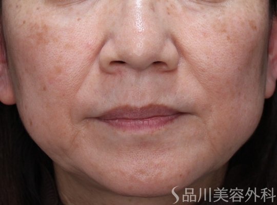 症例NO.72706のBEFORE写真