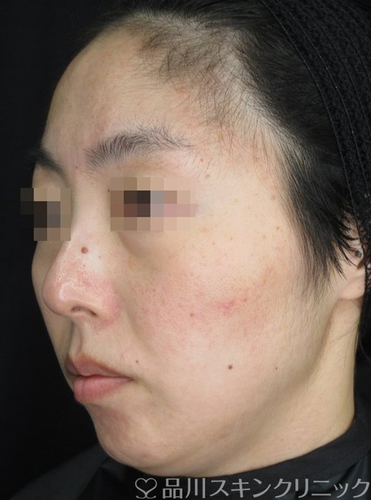 症例NO.71327のBEFORE写真