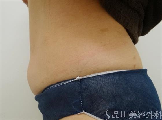 症例NO.20213のAFTER写真