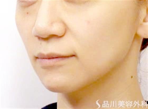 症例NO.26261のBEFORE写真