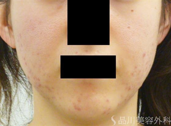 症例NO.24284のBEFORE写真
