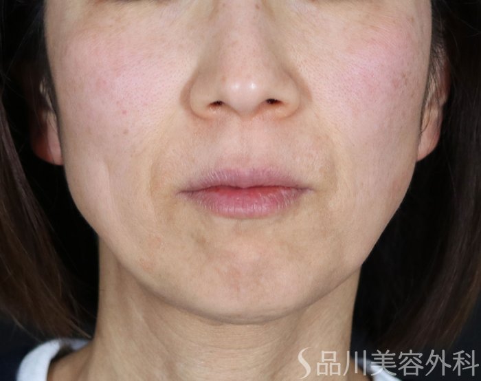 症例NO.73215のBEFORE写真