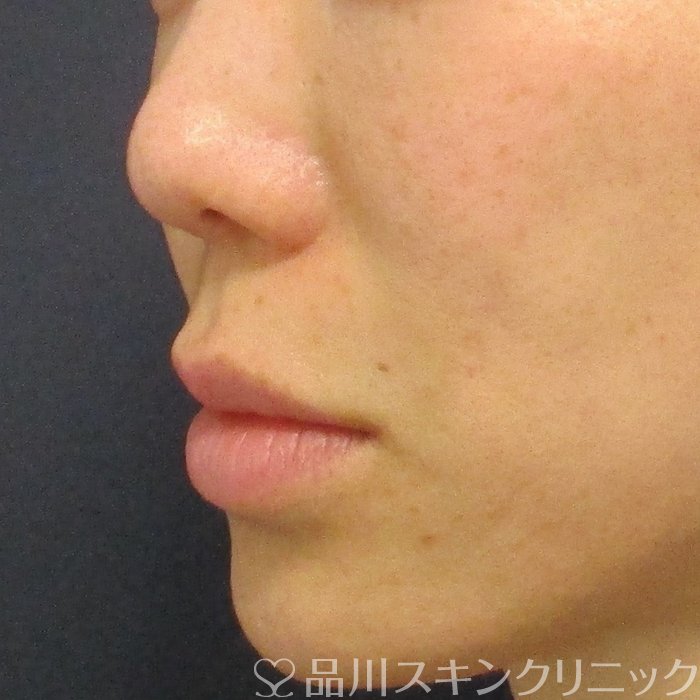 症例NO.74245のAFTER写真