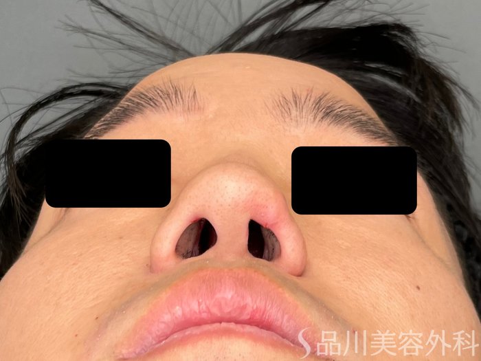 症例NO.73614のBEFORE写真