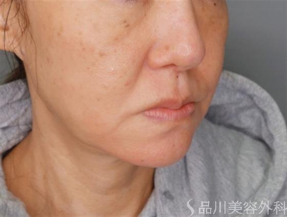 症例NO.55033のBEFORE写真
