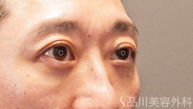 症例NO.75058のAFTER写真
