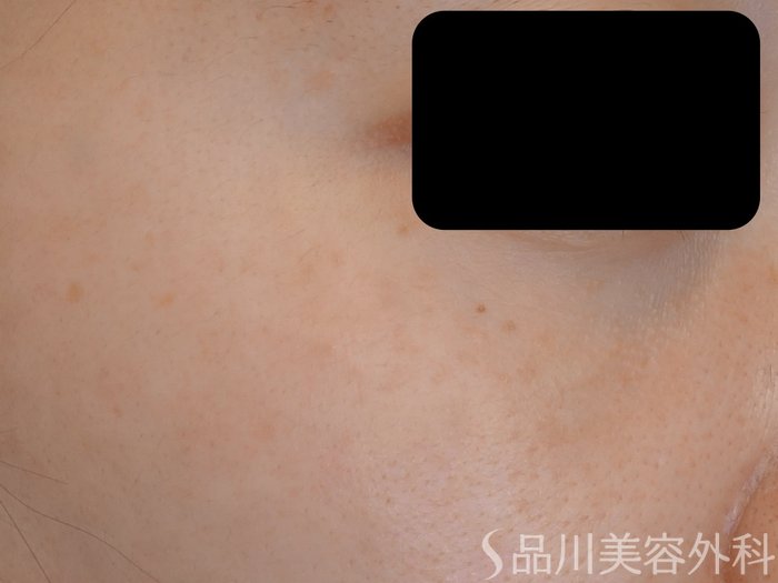 症例NO.72780のAFTER写真