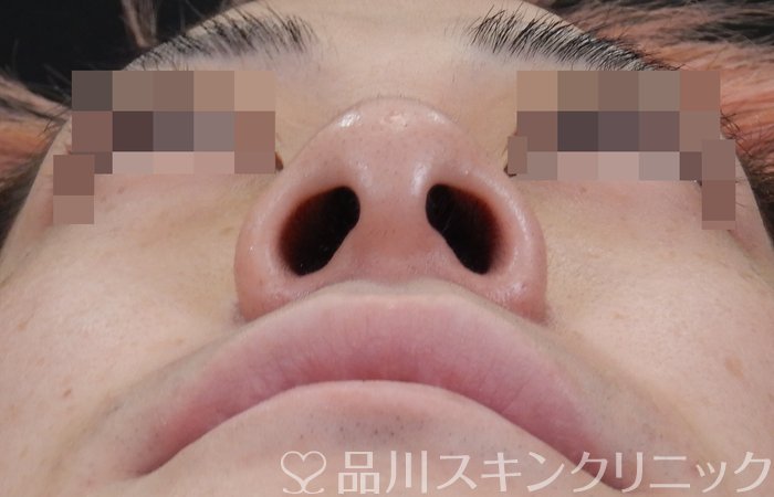 症例NO.65975のAFTER写真