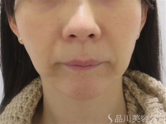 症例NO.24858のBEFORE写真