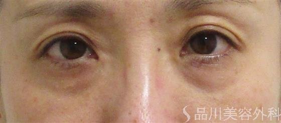 症例NO.55942のBEFORE写真