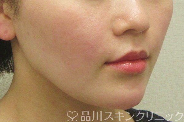 症例NO.75078のAFTER写真