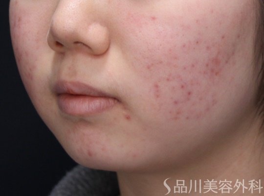 症例NO.67877のBEFORE写真