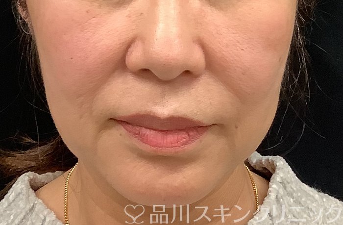 症例NO.67964のBEFORE写真