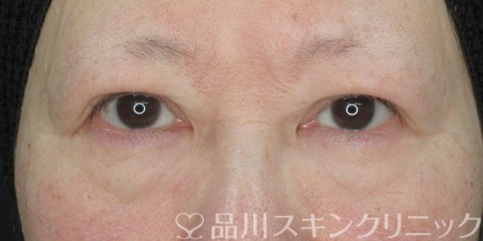 症例NO.75082のBEFORE写真