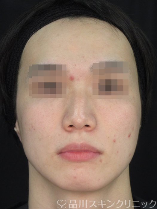 症例NO.73417のBEFORE写真