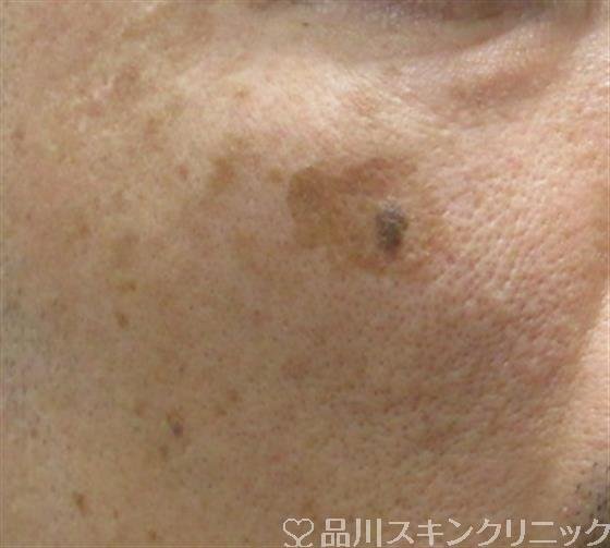 症例NO.33662のBEFORE写真