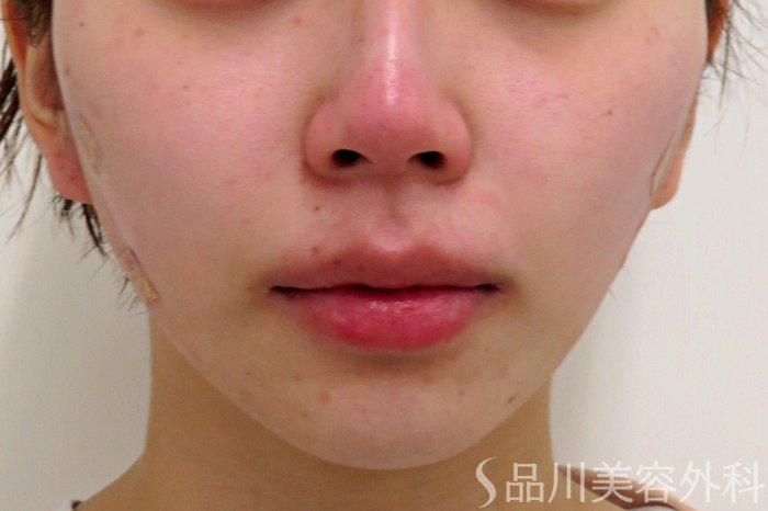 症例NO.74085のAFTER写真