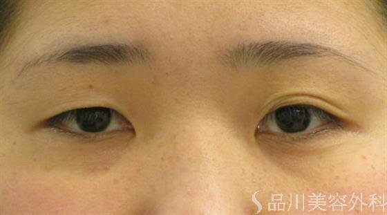 症例NO.48409のBEFORE写真