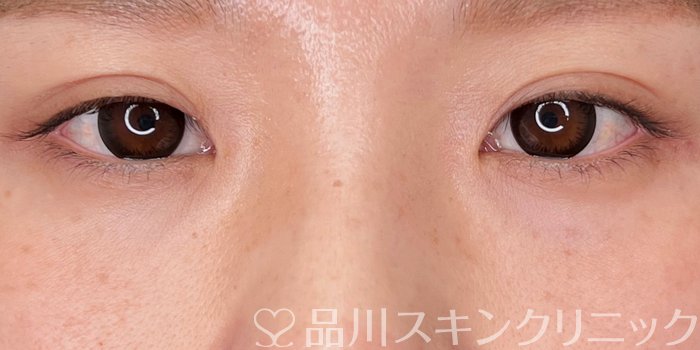 症例NO.69852のAFTER写真