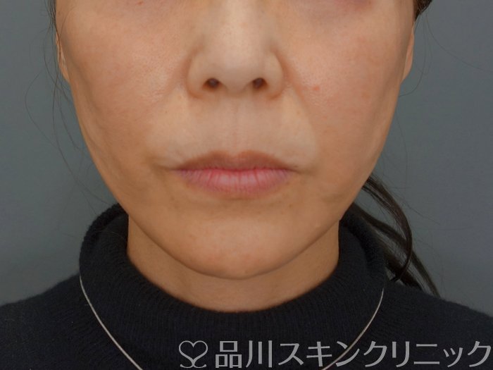 症例NO.74164のAFTER写真