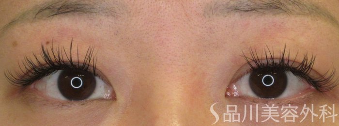 症例NO.70615のBEFORE写真