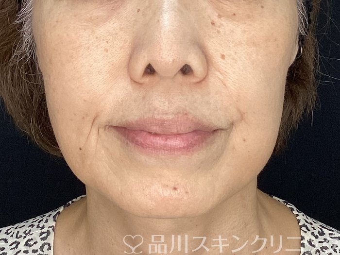 症例NO.71969のBEFORE写真