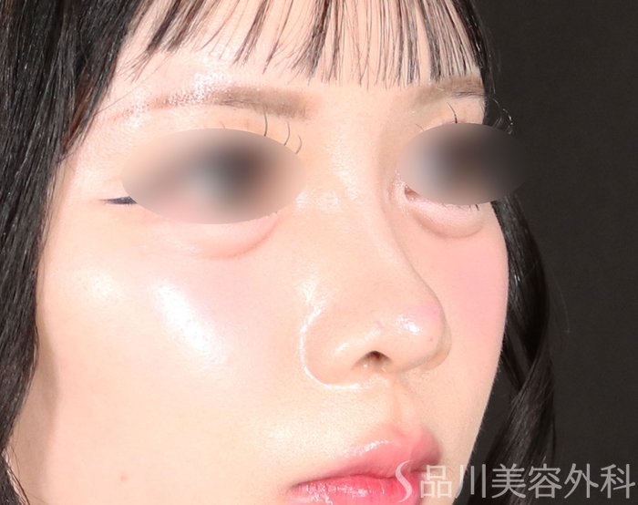 症例NO.74212のBEFORE写真