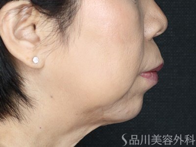 症例NO.72431のAFTER写真