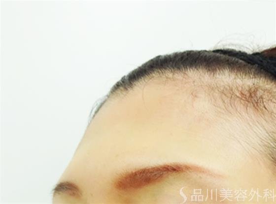 症例NO.42818のBEFORE写真