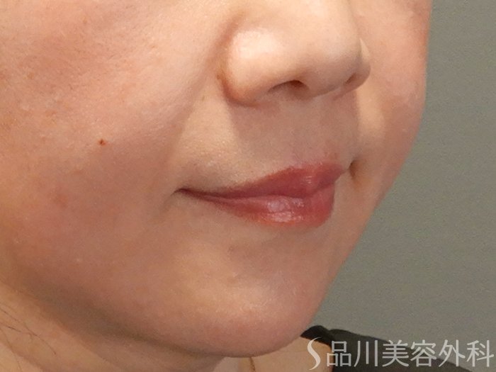 症例NO.70923のBEFORE写真