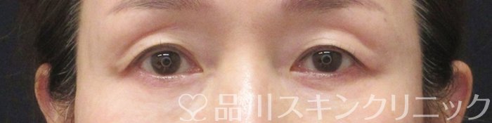 症例NO.62898のBEFORE写真