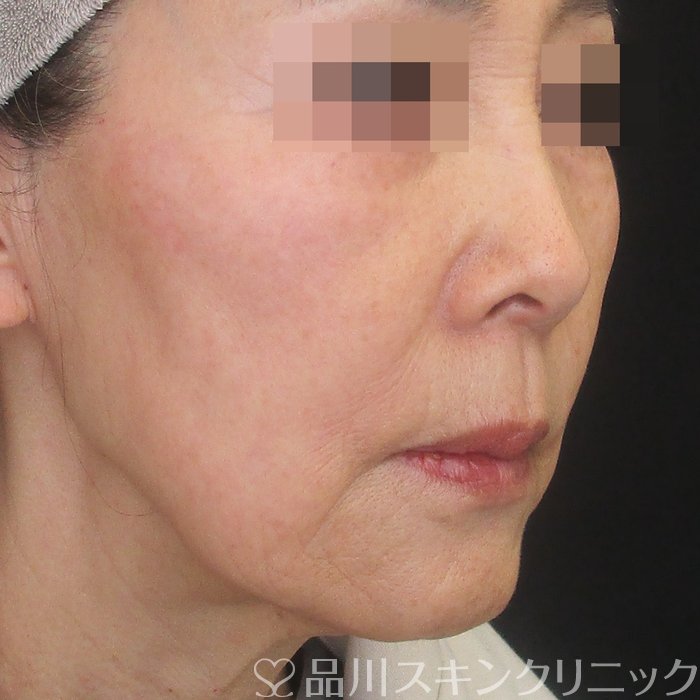 症例NO.73689のAFTER写真