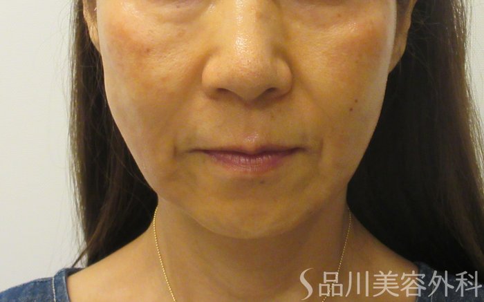 症例NO.71552のAFTER写真
