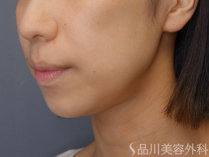 症例NO.72912のBEFORE写真