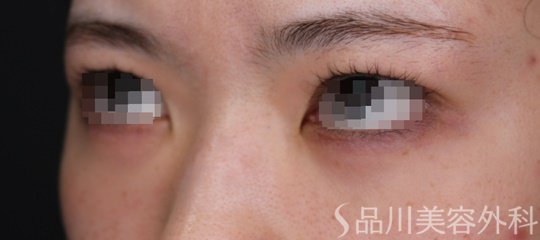症例NO.69525のBEFORE写真