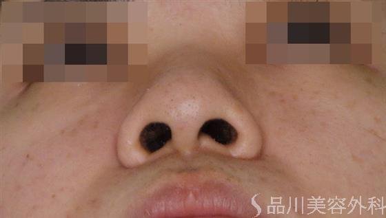 症例NO.51980のBEFORE写真