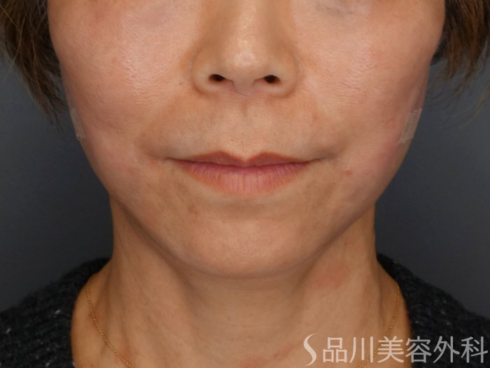 症例NO.72749のAFTER写真