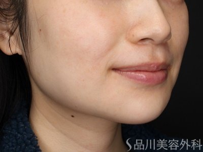 症例NO.69539のBEFORE写真